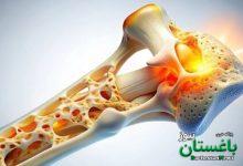 پوکی استخوان