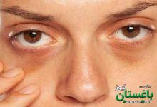 تیرگی دور چشم