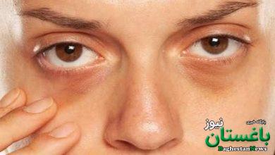 تیرگی دور چشم
